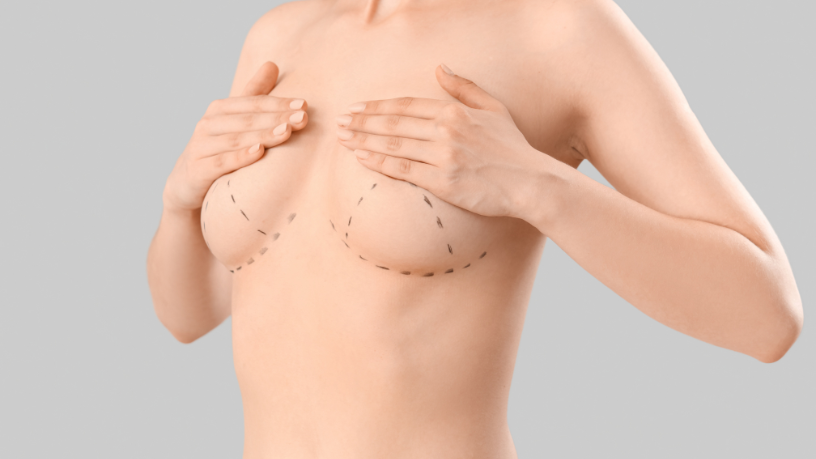 Segundo Milton Seigi Hayashi, a mastopexia moderna busca equilíbrio entre forma, suporte e naturalidade.